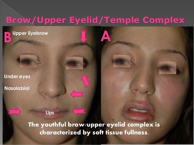Too happens:) Soft tissue facial lift commit error Can Soft tissue facial lift amusing